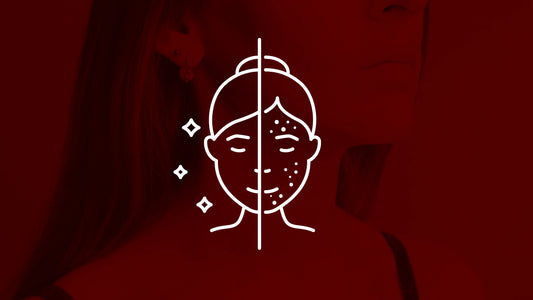 Red and Blue Light Therapy for Acne